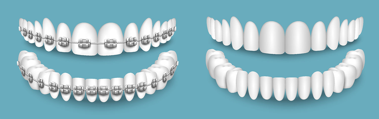 Braces Aligners