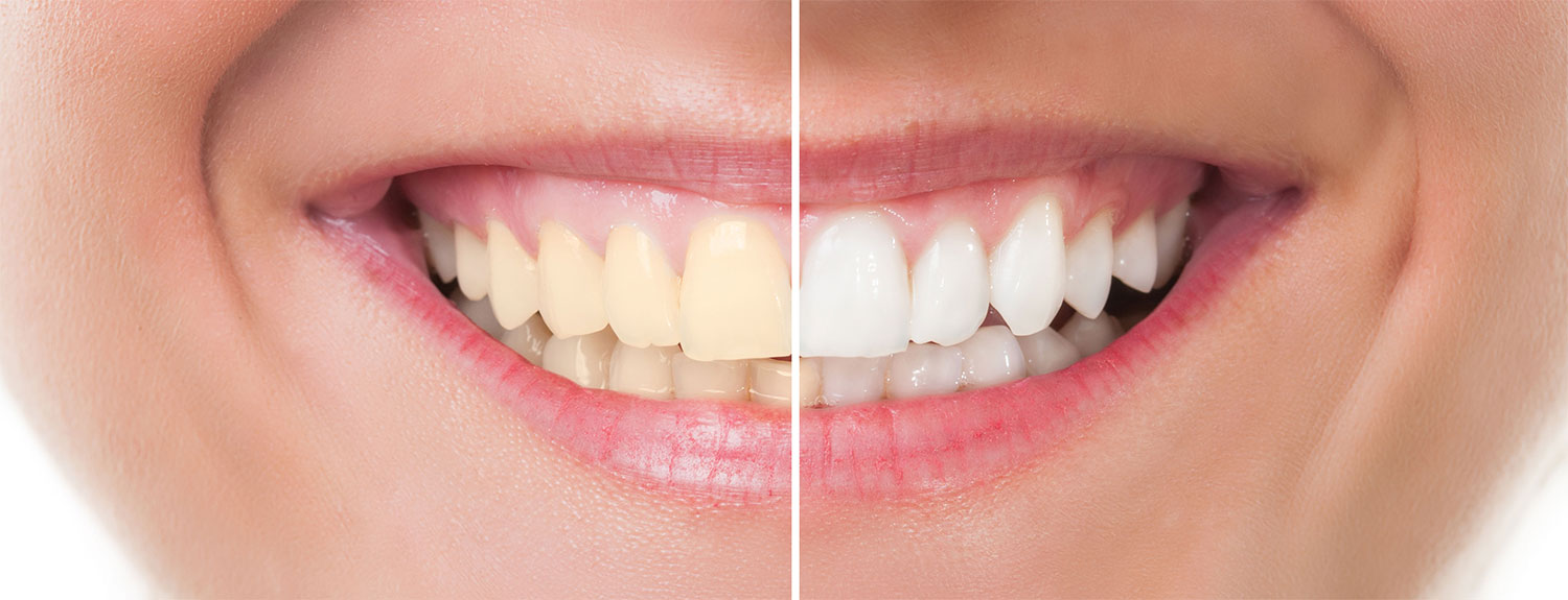 Instant Teeth Whitening