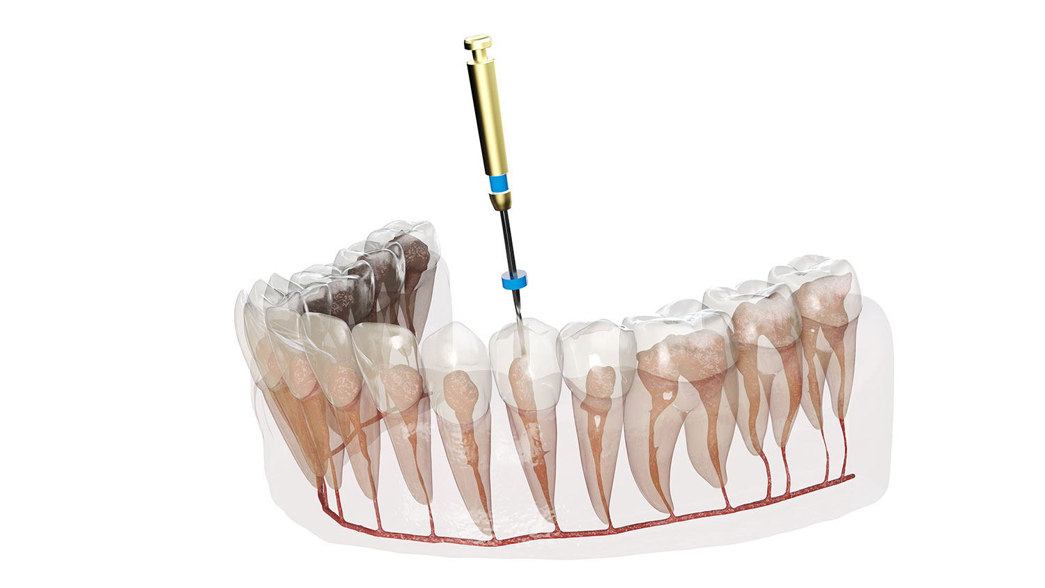 Pain Free Root Canal