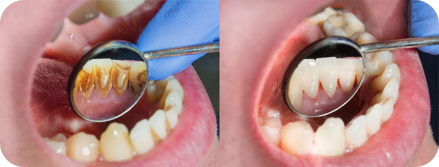 Scaling Polishing Cleaning