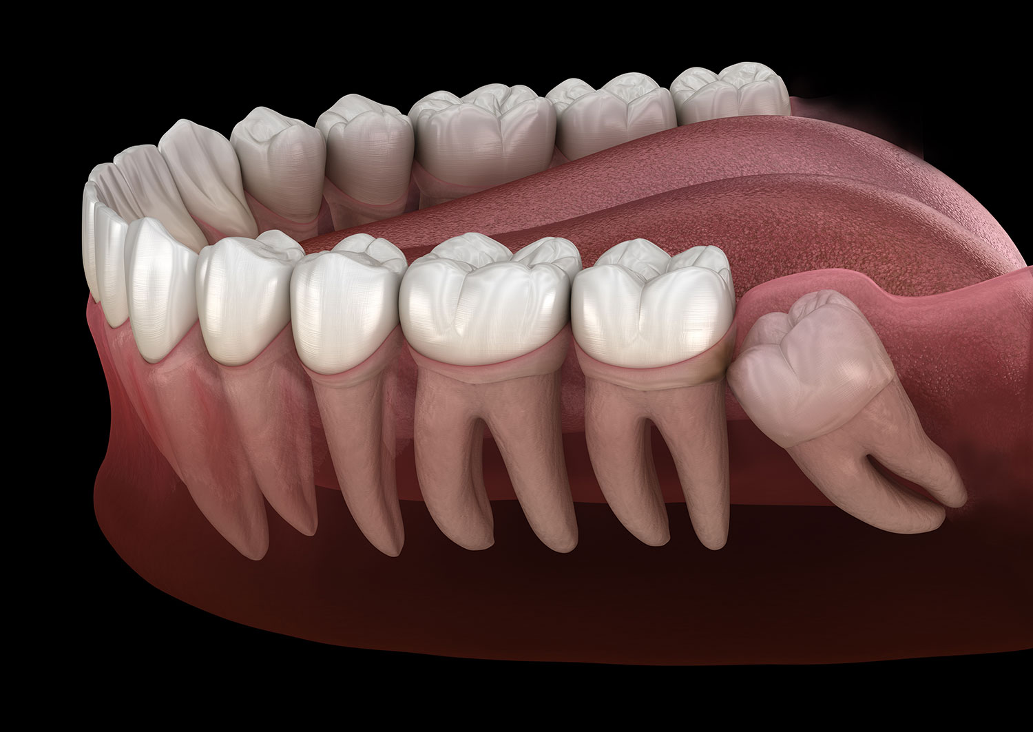 Surgical Tooth Extraction