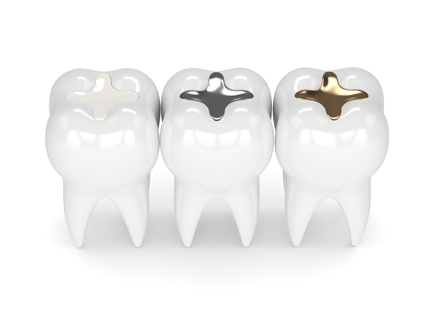 Tooth Coloured Fillings